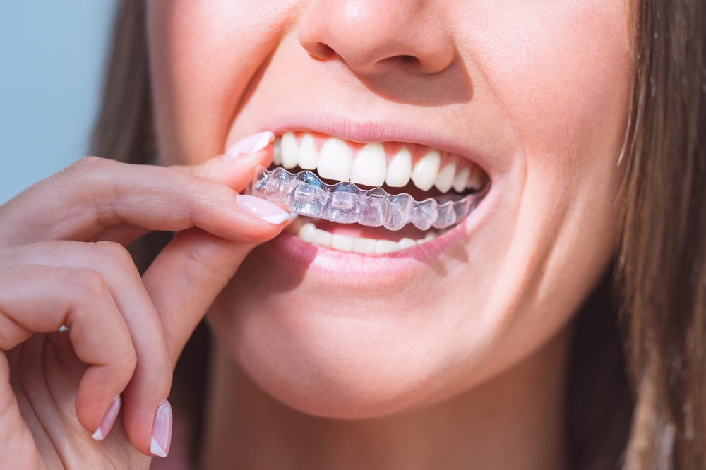 Pdl health during clear aligners treatment