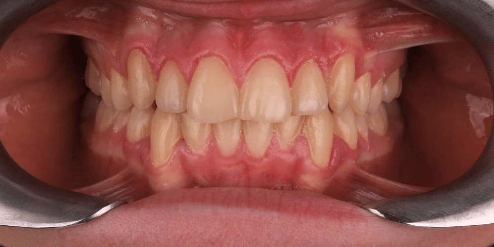 2. After